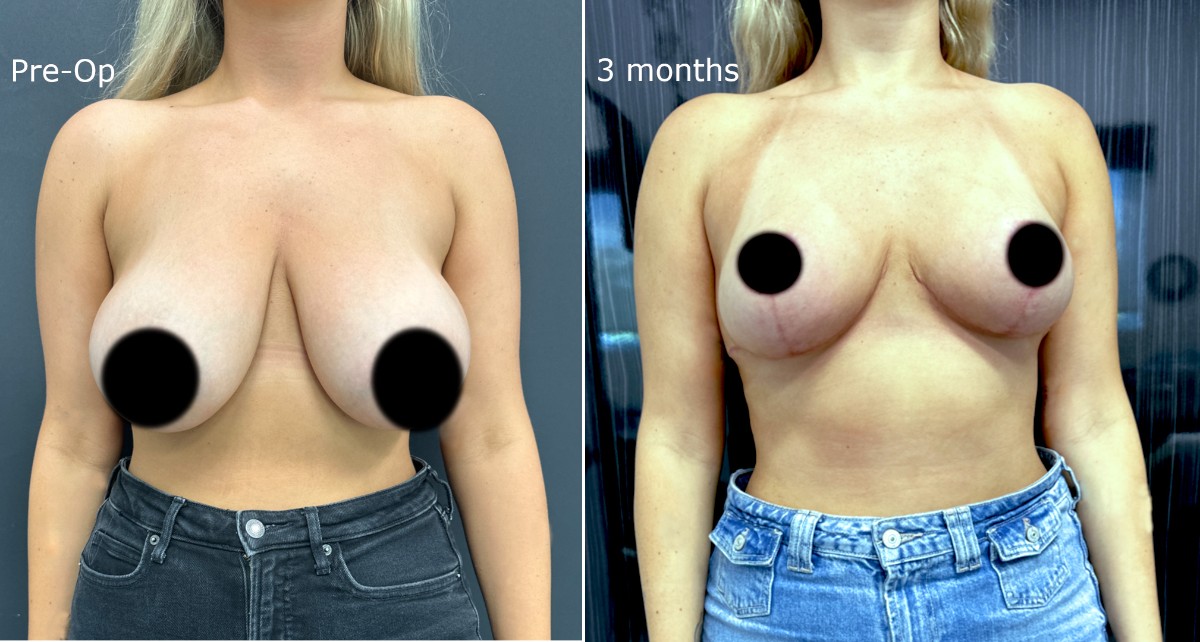 Breast reduction consultation with Dr. Christopher Brooks in Hollywood Florida